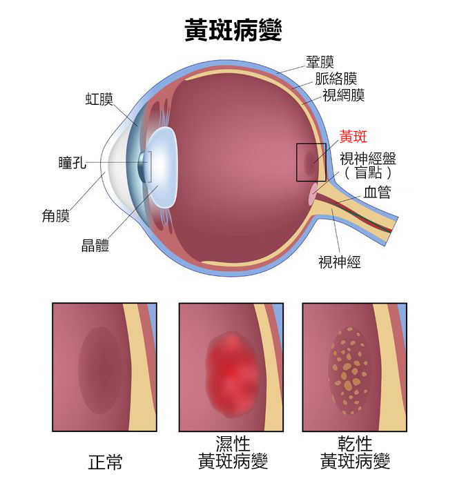 最新特效药治疗黄斑病变，希望之光闪耀